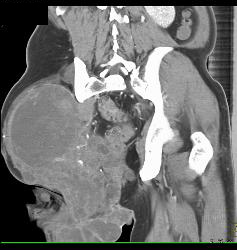 Liposarcoma Thigh - CTisus CT Scan