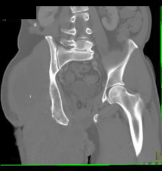 Liposarcoma Thigh - CTisus CT Scan