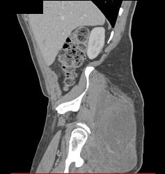 Liposarcoma Thigh - CTisus CT Scan