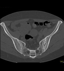 Sacroiliitis With Prior Infection in Joint - CTisus CT Scan