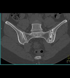 Sacroiliitis With Prior Infection in Joint - CTisus CT Scan