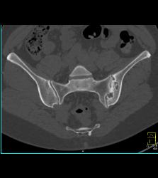 Sacroiliitis With Prior Infection in Joint - CTisus CT Scan