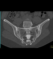 Sacroiliitis With Prior Infection in Joint - CTisus CT Scan