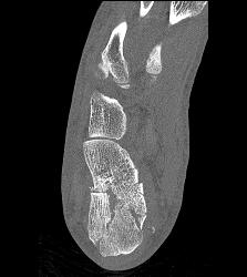 Calcaneus Fracture - CTisus CT Scan