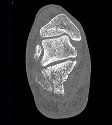 Calcaneus Fracture - CTisus CT Scan