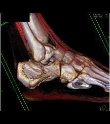 Calcaneus Fracture - CTisus CT Scan