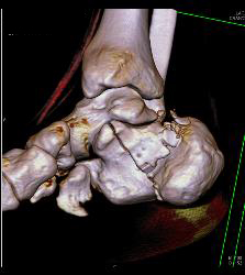 Calcaneus Fracture - CTisus CT Scan