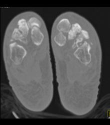 Degenerative Joint Disease (DJD) Metastases - CTisus CT Scan