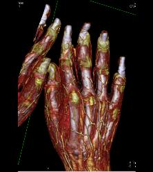 Vasculitis - CTisus CT Scan