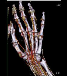 Vasculitis - CTisus CT Scan