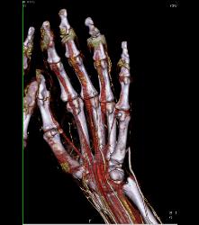 Vasculitis - CTisus CT Scan