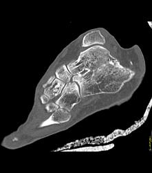 Fusion of Calcaneus and Talus - CTisus CT Scan