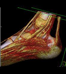 Fusion of Calcaneus and Talus - CTisus CT Scan