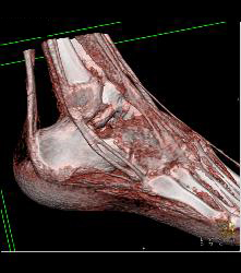 Fusion of Calcaneus and Talus - CTisus CT Scan