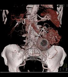 Renal Carcinoma With Vascular Bone Metastases - CTisus CT Scan