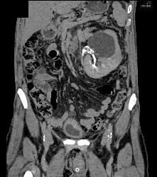 Renal Carcinoma With Vascular Bone Metastases - CTisus CT Scan