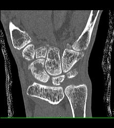 Scaphoid Fracture With Nonunion - CTisus CT Scan