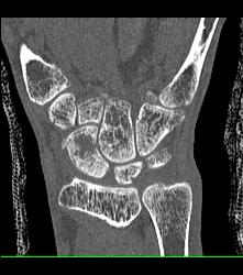 Scaphoid Fracture With Nonunion - CTisus CT Scan