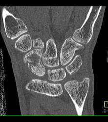 Scaphoid Fracture With Nonunion - CTisus CT Scan