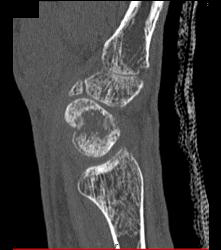 Scaphoid Fracture With Nonunion - CTisus CT Scan