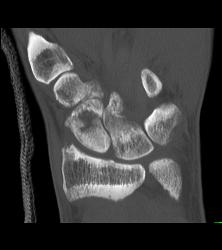 Scaphoid Fracture With Nonunion - CTisus CT Scan