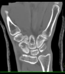 Scaphoid Fracture With Nonunion - CTisus CT Scan