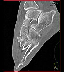 Lisfranc Midfoot Fracture/dislocation - CTisus CT Scan