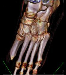 Lisfranc Midfoot Fracture/dislocation - CTisus CT Scan