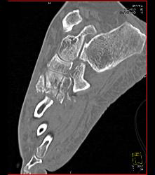 Lisfranc Midfoot Fracture/dislocation - CTisus CT Scan