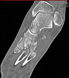 Lisfranc Midfoot Fracture/dislocation - CTisus CT Scan