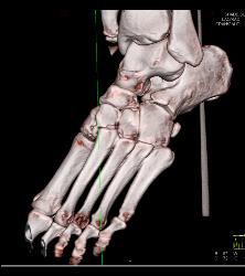 Lisfranc Midfoot Fracture/dislocation - CTisus CT Scan