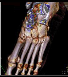 Lisfranc Midfoot Fracture/dislocation - CTisus CT Scan