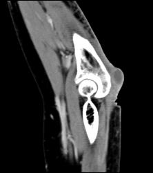 Lisfranc Midfoot Fracture/dislocation - CTisus CT Scan