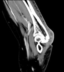 Abscess Elbow - CTisus CT Scan