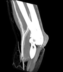 Abscess Elbow - CTisus CT Scan