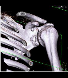 Fracture With Reduced Dislocation - CTisus CT Scan