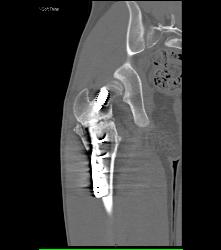 Prior Femur Pinning - CTisus CT Scan