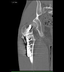 Prior Femur Pinning - CTisus CT Scan