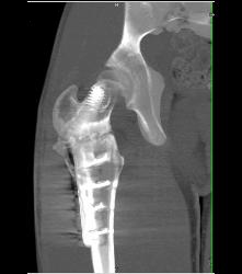 Prior Femur Pinning - CTisus CT Scan