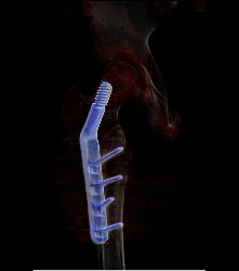 Prior Femur Pinning - CTisus CT Scan