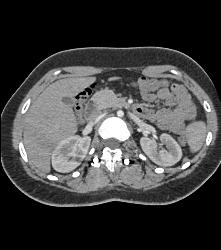 Rod in Spine for Fusion. Screws Come Very Close to Aorta - CTisus CT Scan