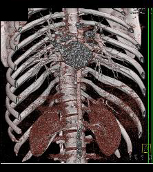 Rod in Spine for Fusion. Screws Come Very Close to Aorta - CTisus CT Scan