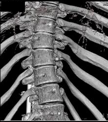 Rod in Spine for Fusion. Screws Come Very Close to Aorta - CTisus CT Scan