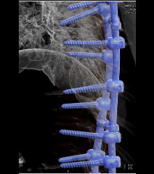 Rod in Spine for Fusion. Screws Come Very Close to Aorta - CTisus CT Scan