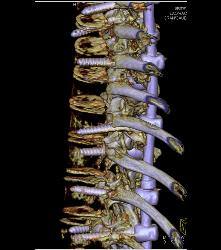 Rod in Spine for Fusion. Screws Come Very Close to Aorta - CTisus CT Scan