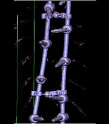 Hardware Abuts Descending Aorta - CTisus CT Scan