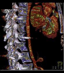 Hardware Abuts Descending Aorta - CTisus CT Scan