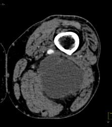 Bakers Cyst - CTisus CT Scan