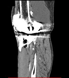 Bakers Cyst - CTisus CT Scan