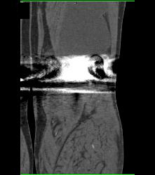 Bakers Cyst - CTisus CT Scan